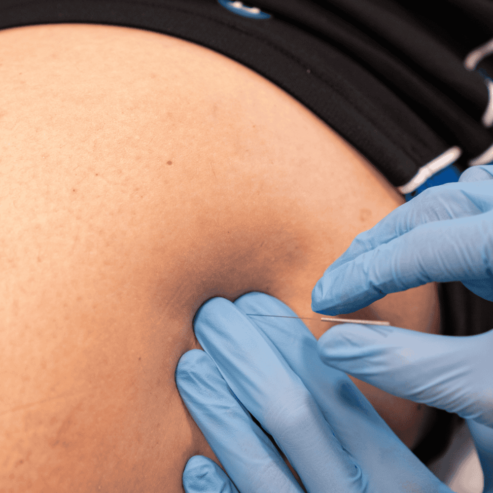 Un chico realizando una sesión de punción seca en un centro de fisioterapia en Santa Eugènia de Berga